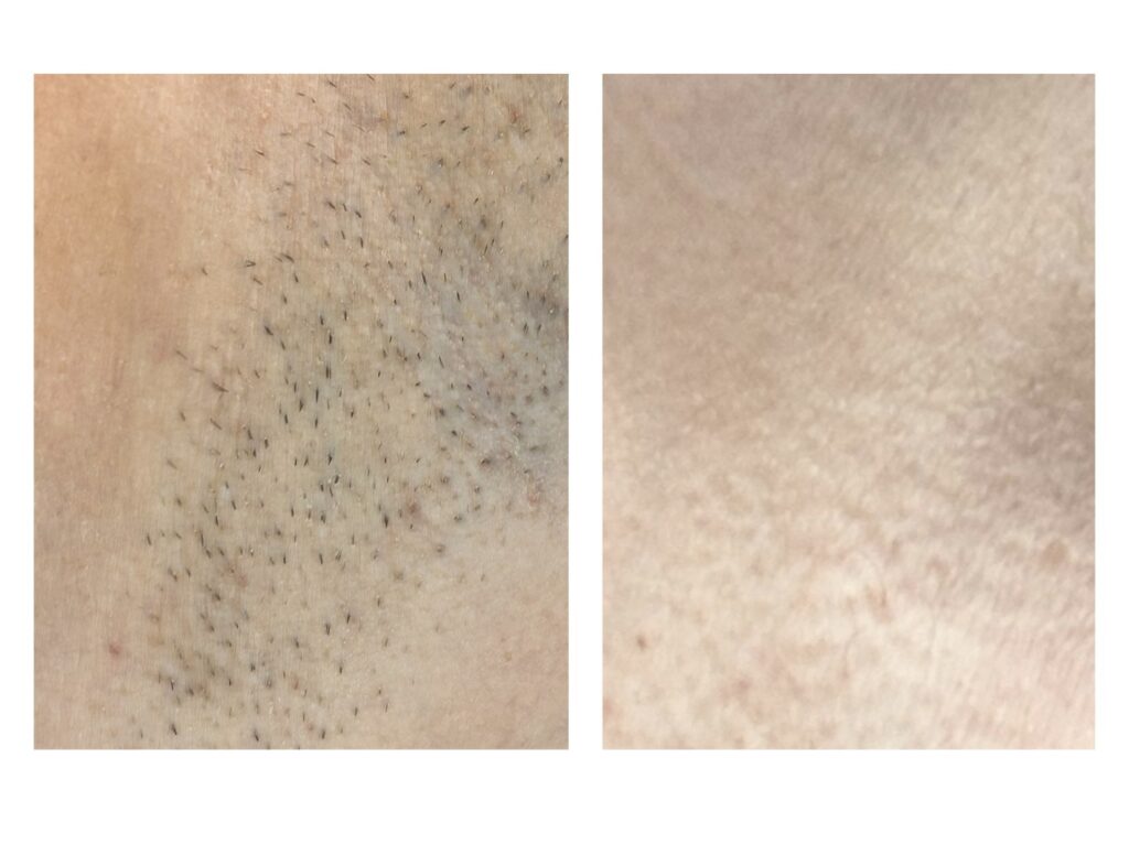 Permanent hårfjerning resultat